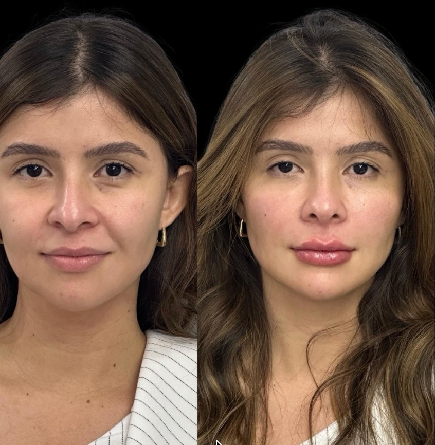 Antes e depois frontal de lábios e terço médio