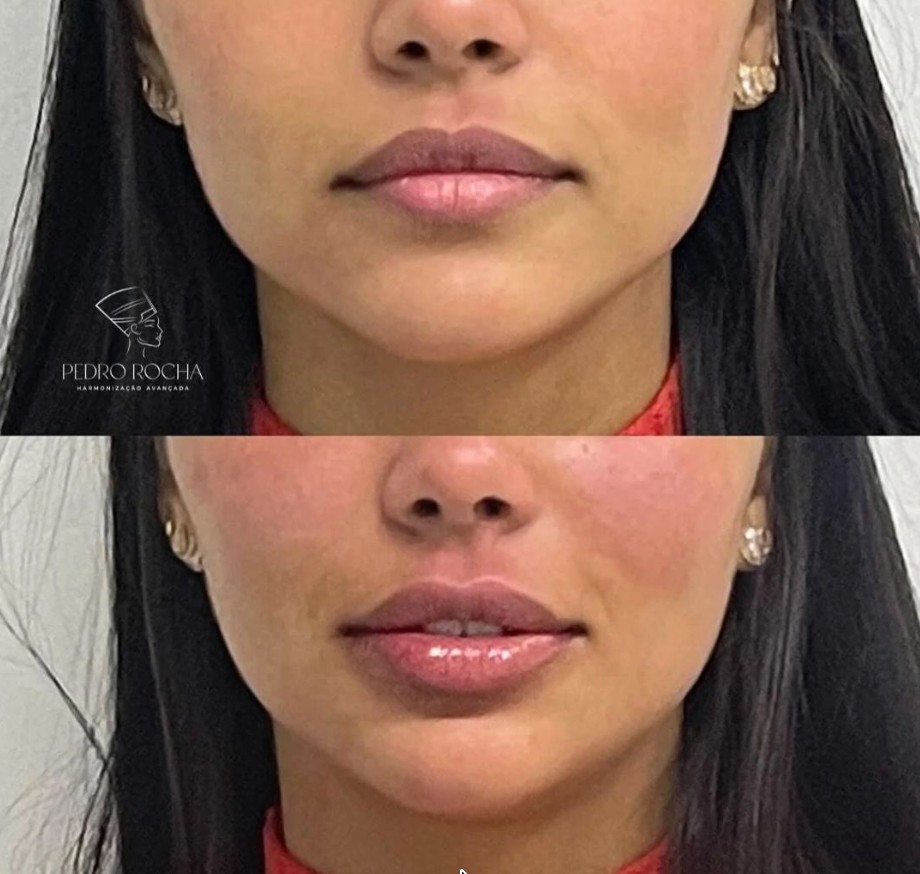 Antes e depois de lábios e mento