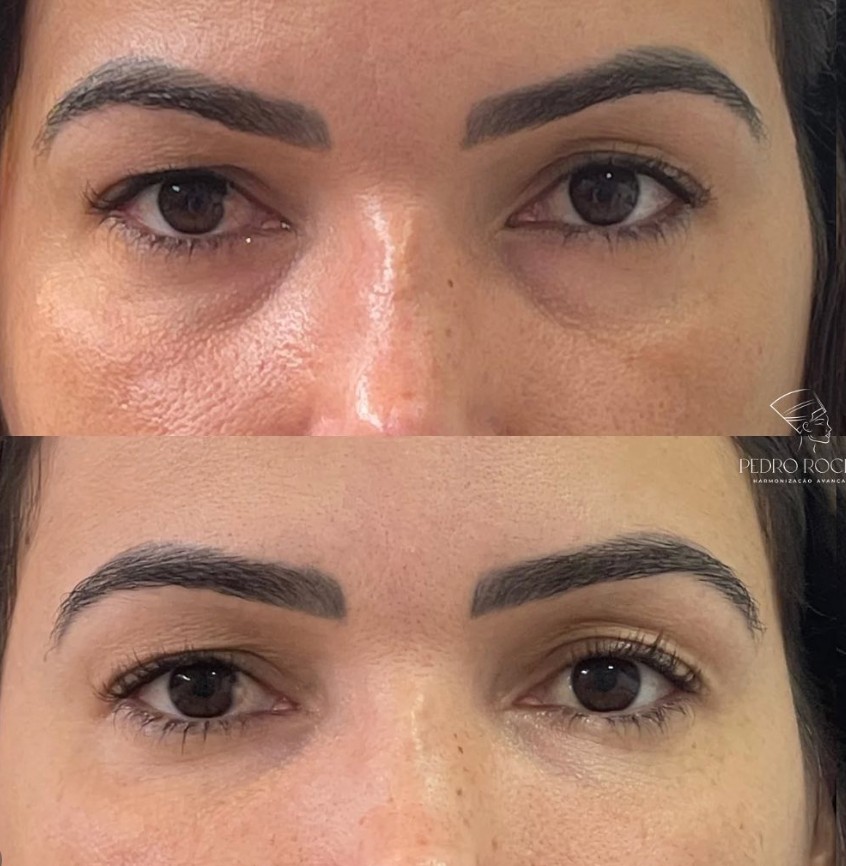 Antes e depois da região das olheiras