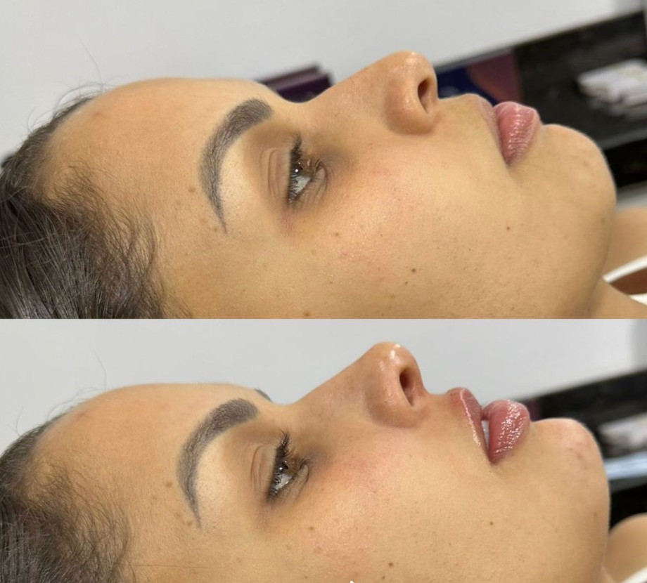 Antes e depois em perfil, nariz e lábios