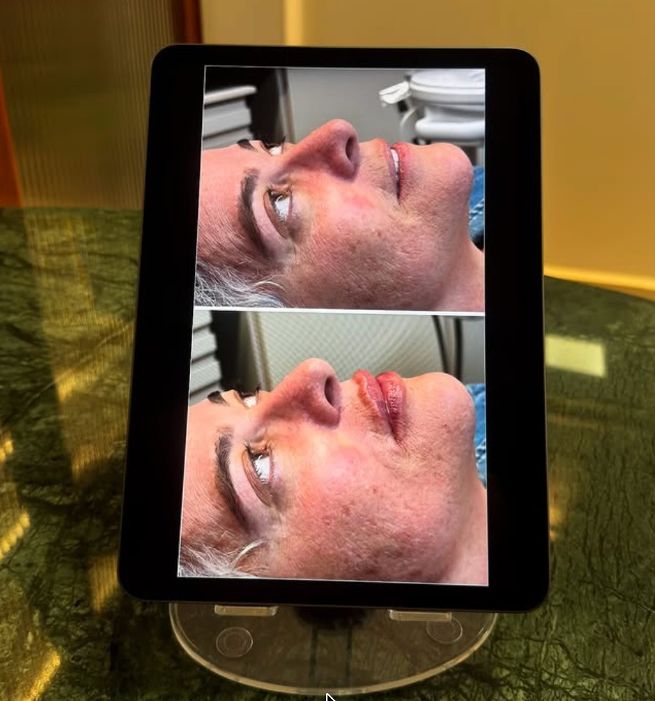 Antes e depois em perfil, apresentados em tablet no consultório